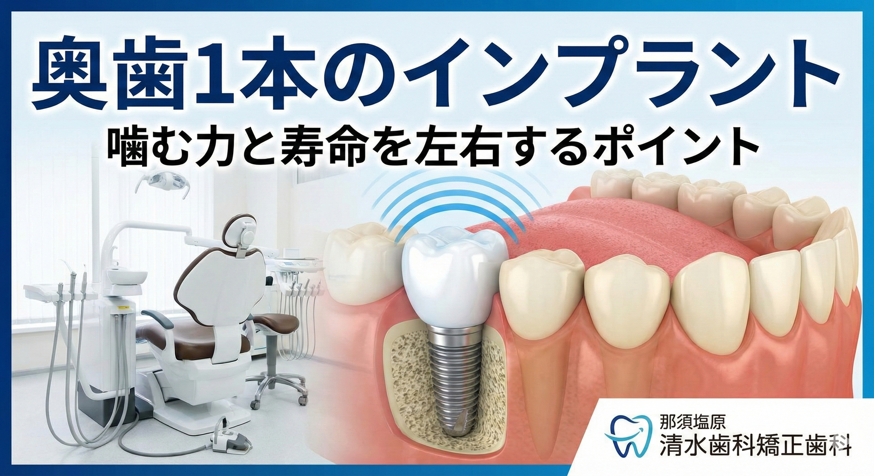 奥歯1本のインプラント｜噛む力と寿命を左右するポイント（那須塩原）